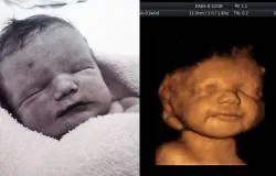 Madre protegió siempre a "sonriente" bebé enfermo ante pedido de aborto de médicos