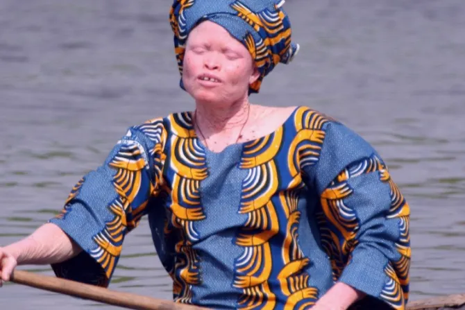 La Iglesia Católica no es indiferente al sufrimiento de los albinos