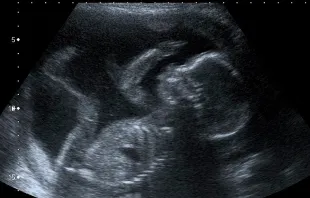 Bebé en el vientre a las 20 semanas, dentro del segundo trimestre, cuando los abortos por desmembramiento se realizan generalmente. Foto: Flickr de Steve (CC BY-NC 2.0) 