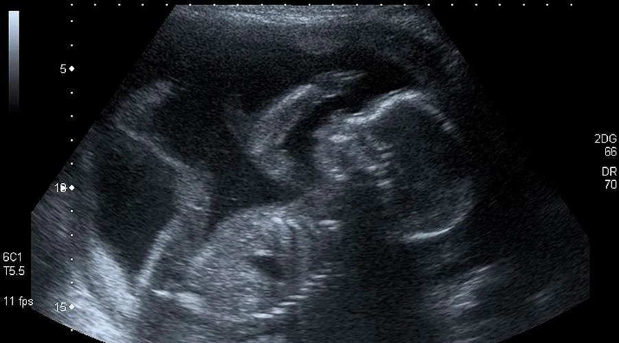 Estudio revela por qué patean los bebés dentro del vientre materno