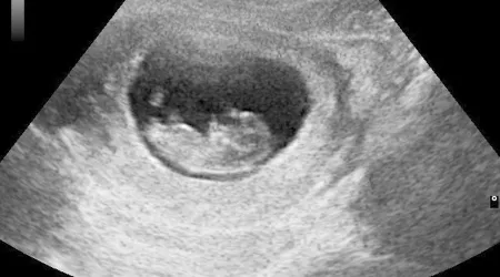Aprueban ley que prohíbe aborto cuando se detectan latidos del corazón del feto