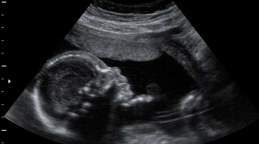 En Sudáfrica grupos abortistas no pueden encontrar médicos dispuestos a realizar abortos