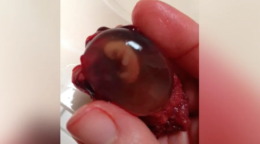 Robusto judío su Aborto: Así se ve un embrión de 7 semanas de gestación