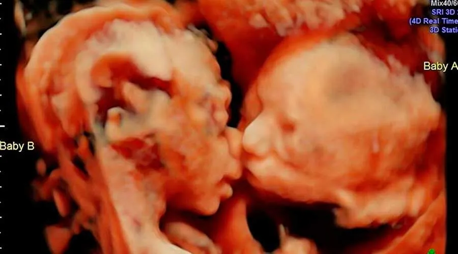 FOTO VIRAL: Ecografía capta a gemelas dándose un tierno beso en el vientre materno