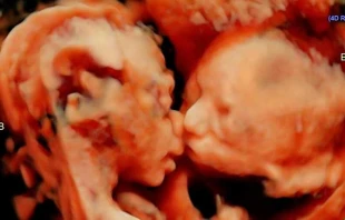 Las gemelas Isabella y Callie compartiendo un gesto de cariu00f1o en el vientre / Foto: Instagram Carissa Gill 