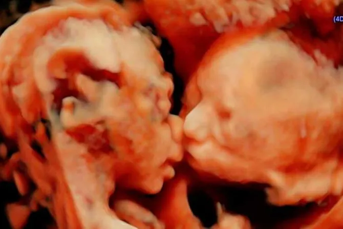 FOTO VIRAL: Ecografía capta a gemelas dándose un tierno beso en el vientre materno