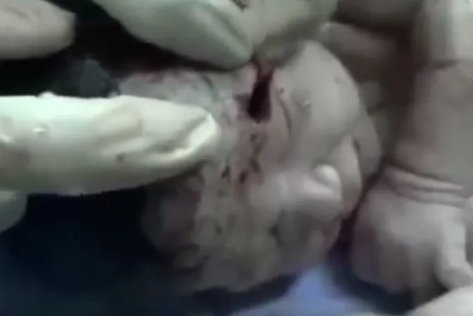 Siria: Nace bebé con metralla incrustada en la frente