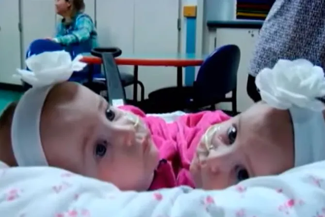 Dos gemelas siamesas: El “milagro” de los padres que dijeron no al aborto