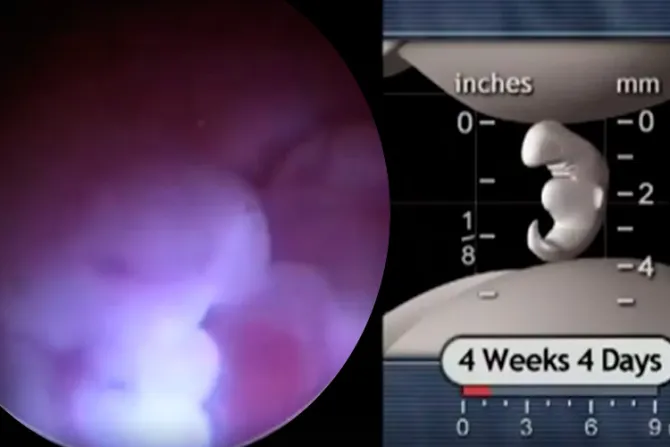 Video viral demuestra que el aborto detiene un corazón en primer mes de gestación 