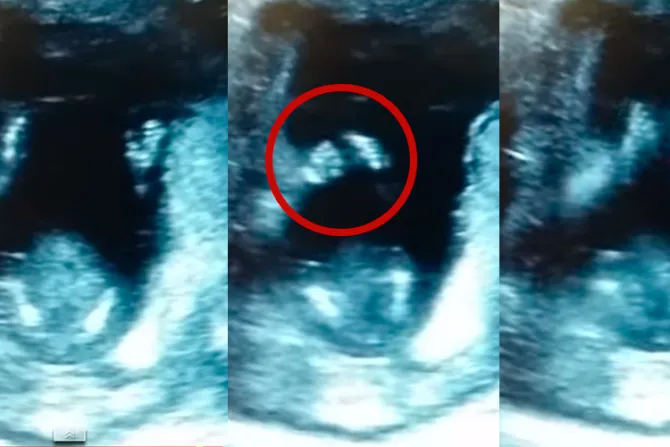 [VIDEO VIRAL] Bebé de solo 14 semanas de gestación “aplaude” durante una ecografía
