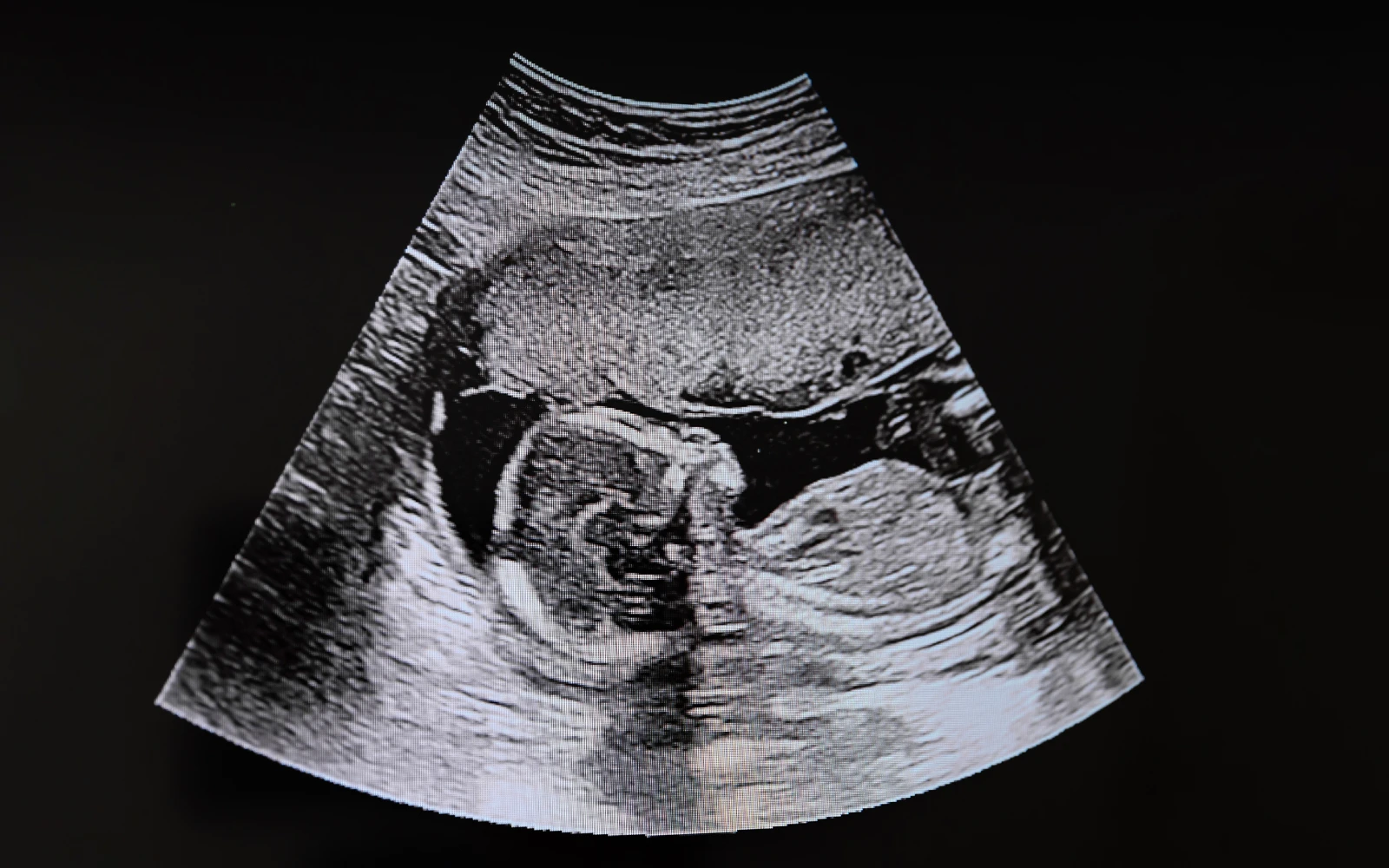 Imagen referencial de bebé en ultrasonido.?w=200&h=150