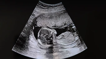 Imagen referencial de bebé en ultrasonido.