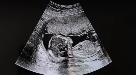 bebé en ultrasonido