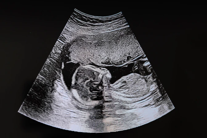 bebé en ultrasonido