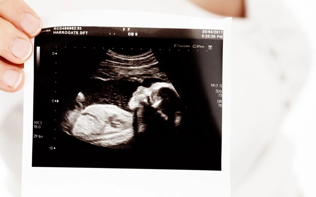 Ecografía de un bebé. Imagen referencial.?w=200&h=150