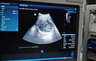 Monitor muestra los resultados de una ecografía. Crédito: Rian Ramadhan Zanuardi - Shutterstock