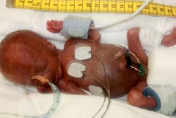Sobrevive en Alemania bebé prematuro con 275 gramos de peso