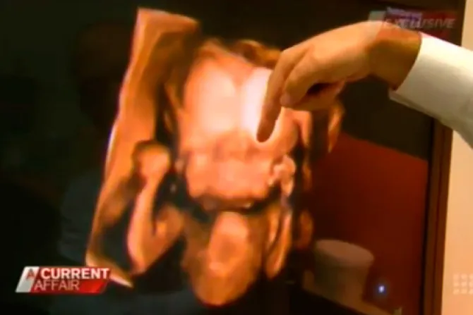 [VIDEO] Padres luchan por salvar del aborto a bebé con dos cerebros y dos caras