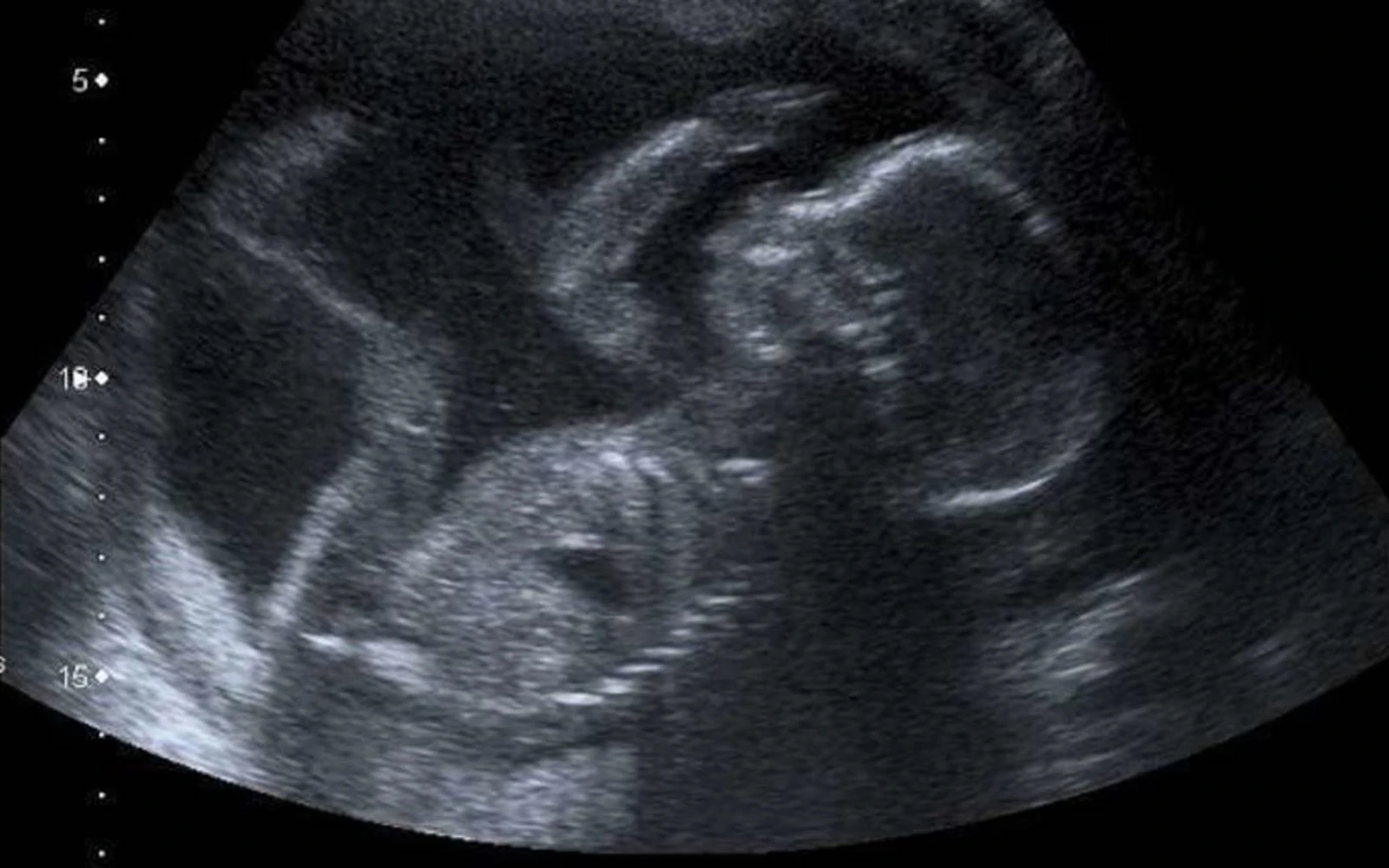 Ultrasonido de un bebé a las 20 semanas de gestación.?w=200&h=150