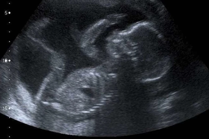 Ultrasonido de un bebé