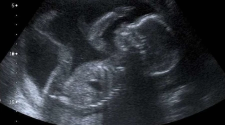 Ultrasonido de un bebé